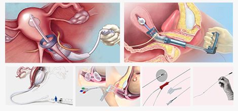 婦產科輔助生殖